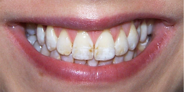 Fluoroseflecken auf den Zähnen behandeln.