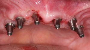 8 Multivorverkleben Implantatposition
