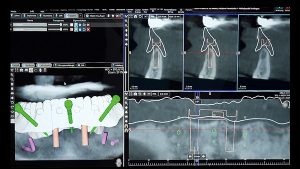 Sofortversorgung 3D-Planung der Implantatposition mit ICX-Magellan