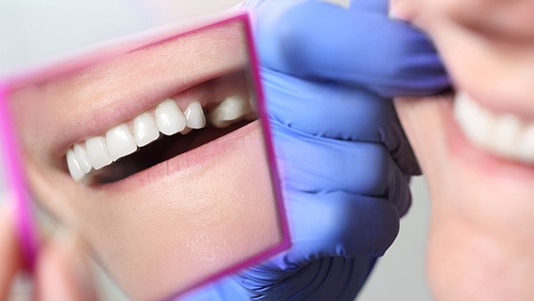 Punktwert Zahnersatz Zahnkrone