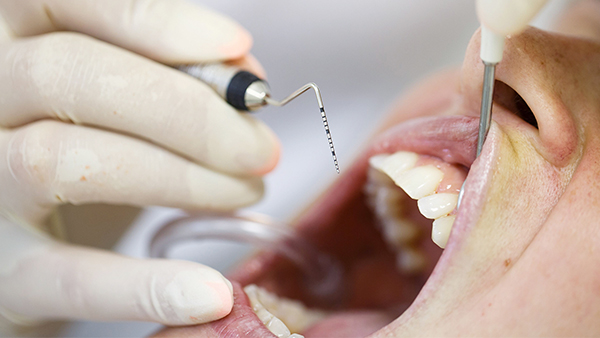 Parodontitis Behandlung