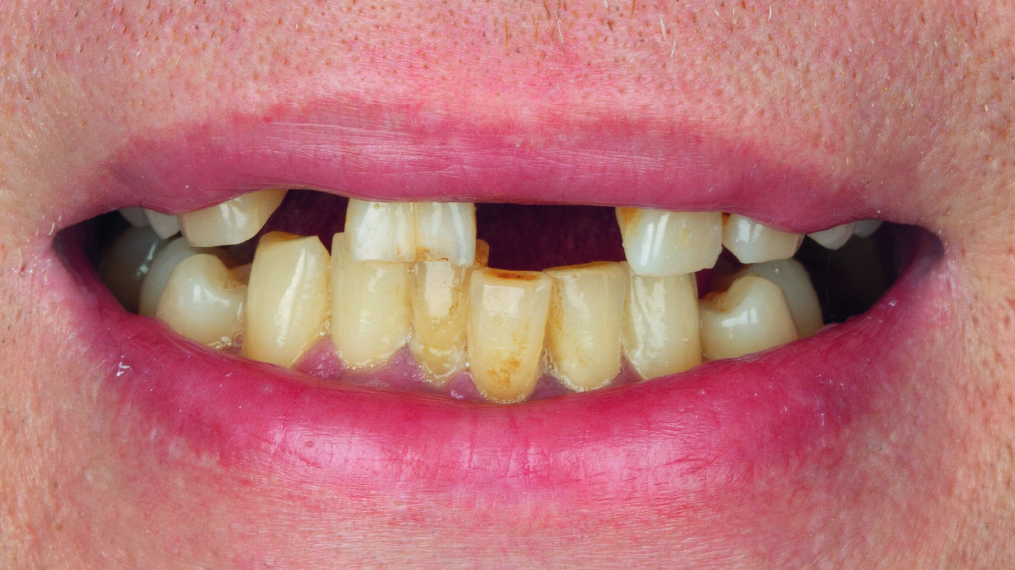 Definitive Befestigung einer Frontzahnbrücke dentalmagazin.de